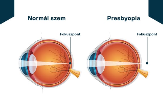 presbyopia