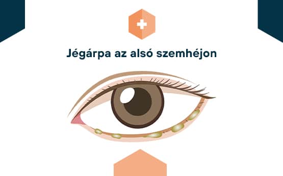 jégárpa a szemhéjon