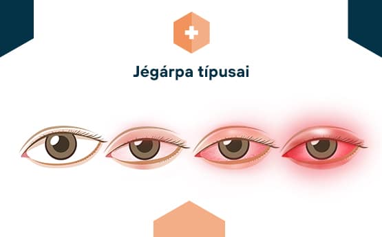 jégárpa típusai
