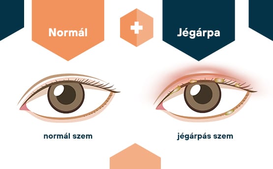 normál szem vs jégárpa