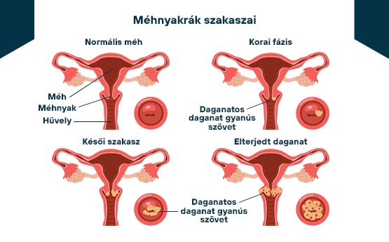 mit okozhat a hpv