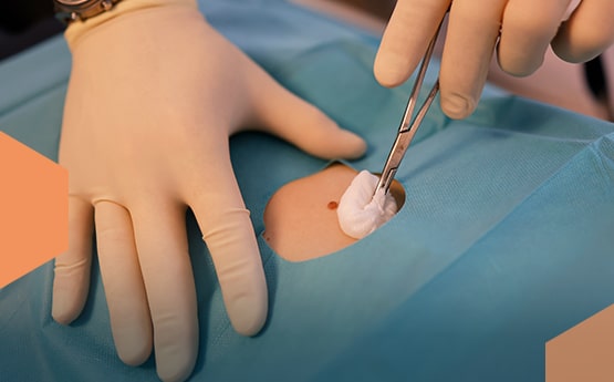 anyajegy eltávolítása